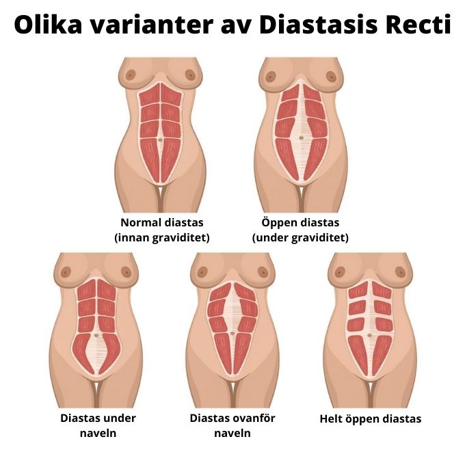Delade magmuskler rektusdiastas Diastasis recti magmuskeldelning efter graviditet