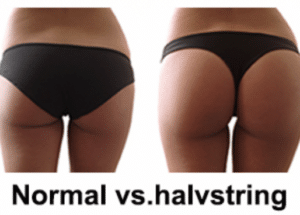 Skillnaden brasiliansk bikinitrosa och halvstring